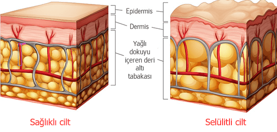 saglikli-selulitli-cilt